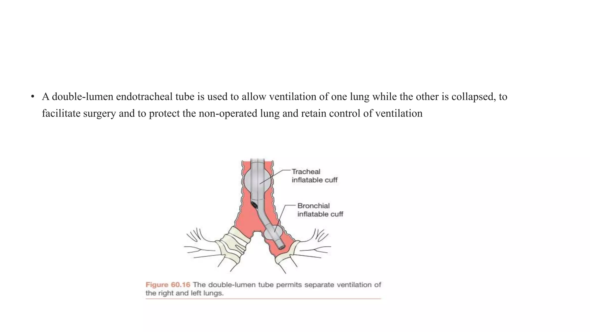 • A double-lumen endotracheal tube is used to allow ventilation of one lung while the other is collapsed, to
facilitate surgery and to protect the non-operated lung and retain control of ventilation
 