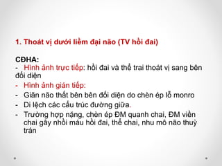 1. Thoát vị dưới liềm đại não (TV hồi đai)
CĐHA:
- Hình ảnh trực tiếp: hồi đai và thể trai thoát vị sang bên
đối diện
- Hình ảnh gián tiếp:
- Giãn não thất bên bên đối diện do chèn ép lỗ monro
- Di lệch các cấu trúc đường giữa.
- Trường hợp nặng, chèn ép ĐM quanh chai, ĐM viền
chai gây nhồi máu hồi đai, thể chai, nhu mô não thuỳ
trán
 