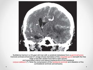 -
Subfalcine hernia in a 33-year-old man with a cerebral metastasis from a germinal tumor.
Coronal contrast-enhanced CT image shows herniation of the cingulate gyrus beneath the free
edge of the falx cerebri from left to right (arrow)
and associated inferior and lateral displacement of the ipsilateral
corpus callosum (*). Note the compression of the ipsilateral ventricle and dilatation of the
contralateral ventricle (arrowheads)
 