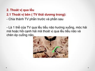 2. Thoát vị qua lều
2.1 Thoát vị bên ( TV thái dương trong):
- Chia thành TV phần trước và phần sau
- Là 1 thể của TV qua lều tiểu não hướng xuống, móc hải
mã hoặc hồi cạnh hải mã thoát vị qua lều tiểu não và
chèn ép cuống não.
 
