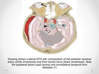 Drawing shows a lateral DTH with compression of the posterior cerebral
artery (white arrowhead) and third cranial nerve (black arrowhead). Note
the ipsilateral blown pupil (arrow) and contralateral temporal horn
dilatation (*)
 