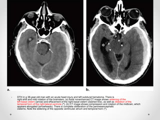 - DTH in a 38-year-old man with an acute head injury and left subdural hematoma. There is
right shift and mild rotation of the brainstem. (a) Axial nonenhanced CT image shows widening of the
left basal cistern (arrow) and effacement of the right basal cistern (dashed line), as well as dilatation of the
temporal horn of the right lateral ventricle (*). (b) CT image shows compression and rotation of the midbrain, which
appears elongated (arrowheads). There is complete obliteration of the perimesencephalic
cisterns. Note the widening of the opposite ventricular atrium and temporal horn (*).
 