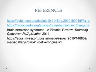 https://pubs.rsna.org/doi/full/10.1148/rg.2019190018#fig1a
https://radiopaedia.org/articles/brain-herniation-1?lang=us
Brain herniation syndroma - A Pictorial Review, Thorsang
Chayovan R1/Aj.Nuttha, 2014
https://epos.myesr.org/posterimage/esr/ecr2019/146862/
mediagallery/787641?deliveroriginal=1
REFERENCES
 