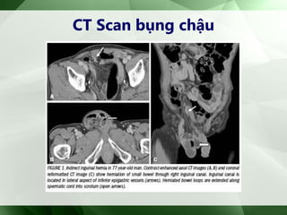 CT Scan bụng chậu
 