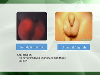Tràn dịch tinh mạc U nang thừng tinh
Khối căng khi
- Ho hay phình bụng không tăng kích thước
- Soi đèn
 