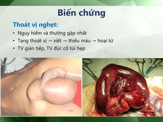 Thoát vị nghẹt:
• Nguy hiểm và thường gặp nhất
• Tạng thoát vị → xiết → thiếu máu → hoại tử
• TV gián tiếp, TV đùi: cổ túi hẹp
Biến chứng
 