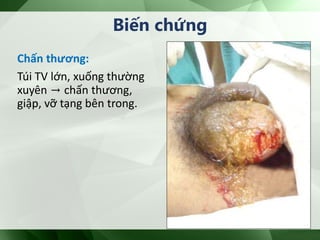 Chấn thương:
Túi TV lớn, xuống thường
xuyên → chấn thương,
giập, vỡ tạng bên trong.
Biến chứng
 