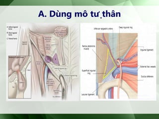 A. Dùng mô tựthân
 
