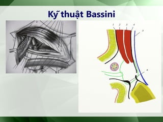 Kỹ thuật Bassini
 