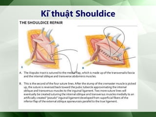 Kĩ thuật Shouldice
 