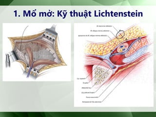 1. Mổ mở: Kỹ thuật Lichtenstein
 