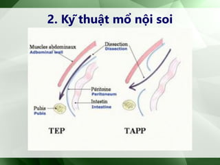 2. Kỹ thuật mổ nội soi
 