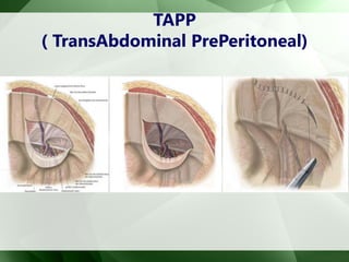 TAPP
( TransAbdominal PrePeritoneal)
 