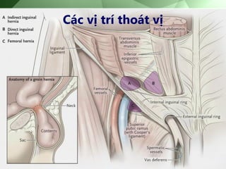 Các vị trí thoát vị
 