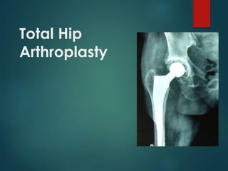 Total Hip
Arthroplasty
 