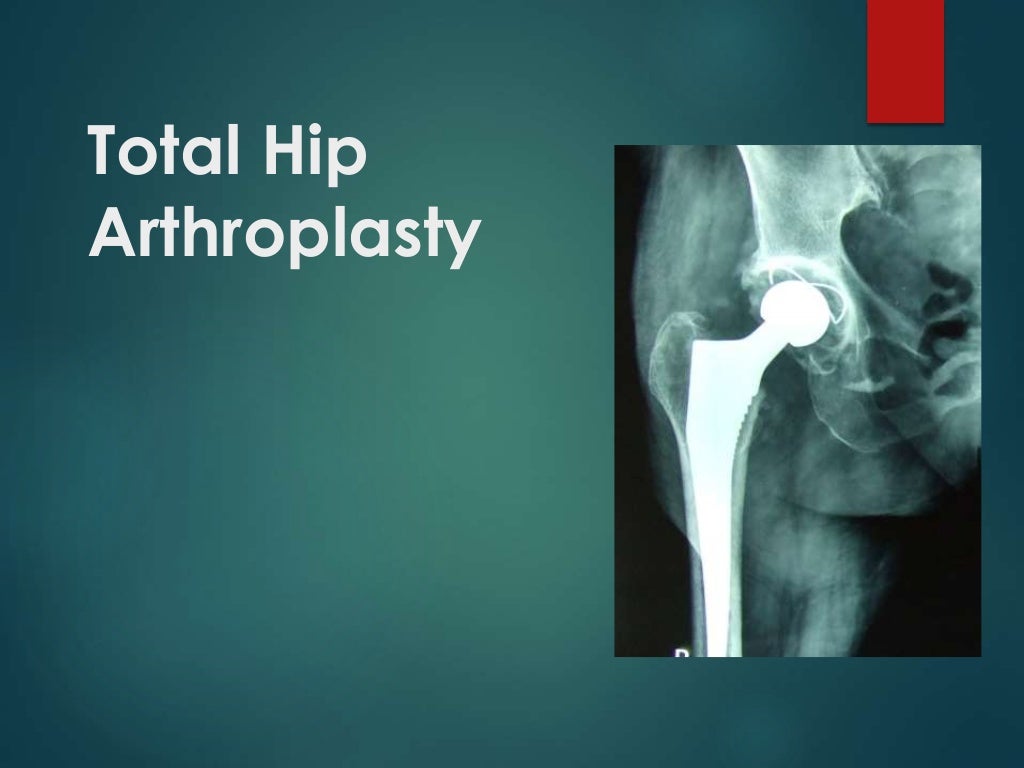 total hip arthroplasty