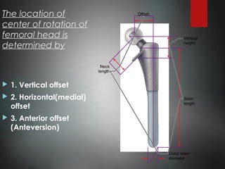 The location of
center of rotation of
femoral head is
determined by
 1. Vertical offset
 2. Horizontal(medial)
offset
 3. Anterior offset
(Anteversion)
 