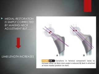 MEDIAL RESTORATION
IS SIMPLY CORRECTED
BY MAKING NECK
ADJUSTMENT BUT……
LIMB LENGTH INCREASES
 