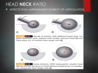 HEAD NECK RATIO
 AFFECTS ROM ,IMPINGEMENT,STABILITY OF ARTICULATION.
 