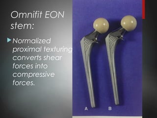 Omnifit EON
stem:
Normalized
proximal texturing
converts shear
forces into
compressive
forces.
 
