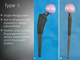Type 1:
 Single Wedge stem
 Flat in AP plane and
tapered in Medio-
lateral Plane.
 Fixation is by cortical
Engangement in
Medio-lateral plane
and 3 bony point
fixation.
 