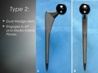 Type 2:
 Dual Wedge stem
 Engages in AP
and Medio-lateral
Planes.
 