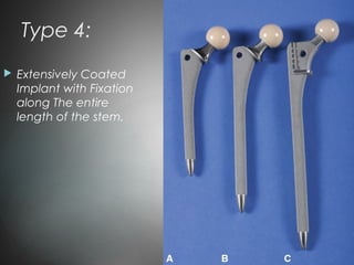 Type 4:
 Extensively Coated
Implant with Fixation
along The entire
length of the stem.
 