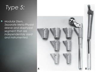 Type 5:
 Modular Stem,
Separate Meta-Physial
sleeve and diaphysial
segment that are
independentaly sized
and instrumented.
 