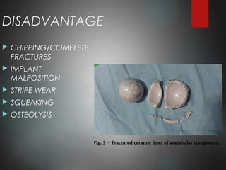 DISADVANTAGE
 CHIPPING/COMPLETE
FRACTURES
 IMPLANT
MALPOSITION
 STRIPE WEAR
 SQUEAKING
 OSTEOLYSIS
 