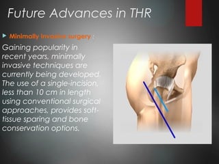 Future Advances in THR
 Minimally invasive surgery :
Gaining popularity in
recent years, minimally
invasive techniques are
currently being developed.
The use of a single-incision,
less than 10 cm in length
using conventional surgical
approaches, provides soft-
tissue sparing and bone
conservation options.
 