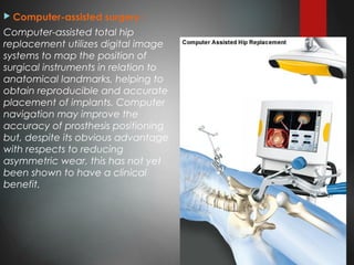  Computer-assisted surgery :
Computer-assisted total hip
replacement utilizes digital image
systems to map the position of
surgical instruments in relation to
anatomical landmarks, helping to
obtain reproducible and accurate
placement of implants. Computer
navigation may improve the
accuracy of prosthesis positioning
but, despite its obvious advantage
with respects to reducing
asymmetric wear, this has not yet
been shown to have a clinical
benefit.
 