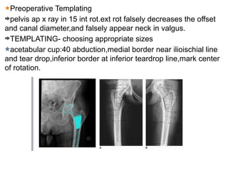 Preoperative Templating
pelvis ap x ray in 15 int rot.ext rot falsely decreases the offset
and canal diameter,and falsely appear neck in valgus.
TEMPLATING- choosing appropriate sizes
acetabular cup:40 abduction,medial border near ilioischial line
and tear drop,inferior border at inferior teardrop line,mark center
of rotation.
 