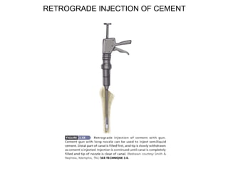 RETROGRADE INJECTION OF CEMENT
 