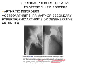SURGICAL PROBLEMS RELATIVE
TO SPECIFIC HIP DISORDERS
ARTHRITIC DISORDERS
OSTEOARTHRITIS (PRIMARY OR SECONDARY
HYPERTROPHIC ARTHRITIS OR DEGENERATIVE
ARTHRITIS)
 