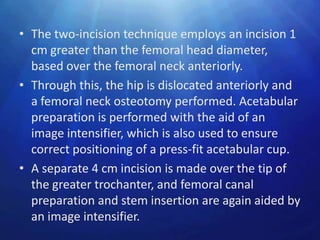• The two-incision technique employs an incision 1
  cm greater than the femoral head diameter,
  based over the femoral neck anteriorly.
• Through this, the hip is dislocated anteriorly and
  a femoral neck osteotomy performed. Acetabular
  preparation is performed with the aid of an
  image intensifier, which is also used to ensure
  correct positioning of a press-fit acetabular cup.
• A separate 4 cm incision is made over the tip of
  the greater trochanter, and femoral canal
  preparation and stem insertion are again aided by
  an image intensifier.
 