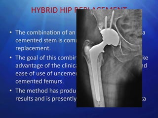 HYBRID HIP REPLACEMENT

• The combination of an uncemented socket and a
  cemented stem is commonly called hybrid hip
  replacement.
• The goal of this combination of implants is to take
  advantage of the clinical reliability, durability, and
  ease of use of uncemented sockets and
  cemented femurs.
• The method has produced excellent midterm
  results and is presently popular in North America
 