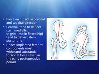 • Force on hip act in coronal
  and saggital direction
• Coronal- tend to deflect
  stem medially ,
  saggital(esp in flexed hip)-
  tend to deflect stem
  posteriorly
• Hence Implanted femoral
  components must
  withstand substantial
  torsional forces even in
  the early postoperative
  period
 