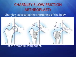 CHARNLEY’S LOW FRICTION
           ARTHROPLASTY
Charnley advocated the shortening of the body
  weight lever arm by
• Deepening the acetabulum and by using small
  head.

    Lengthen the abductor lever arm by

• Reattaching the osteotomised greater trochanter
  laterally or
• By increasing offset between the head and stem
  of the femoral component.
 