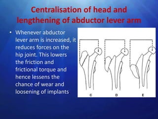 Centralisation of head and
   lengthening of abductor lever arm
• Whenever abductor
  lever arm is increased, it
  reduces forces on the
  hip joint. This lowers
  the friction and
  frictional torque and
  hence lessens the
  chance of wear and
  loosening of implants.
 