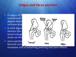 Valgus and Varus position

• A valgus of the head and neck of the femoral
  component relative to the femoral shaft more than 140
  degree decrease the movement of bending and
  increase proportionally the axial loading of the stem
• A mild degree of valgus is usually desirable, but it does
  shorten the abductor lever arm mechanism and also
  tend to lengthen the limb,may result in the valgus
  strain on the knee.
• varus position of the head and neck segment of the
  femoral component must be avoided because it
  increases risk of loosening,wearing and stem failure.
 