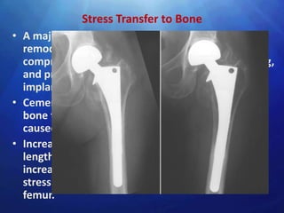 Stress Transfer to Bone
• A major concern with THR is that adaptive bone
  remodeling arising from stress shielding
  compromises implant support, produces loosening,
  and predisposes to fracture of the femur or the
  implant itself.
• Cementless stems generally produce strains in the
  bone that are more physiological than the strains
  caused by fully cemented stems
• Increasing the modulus of elasticity, the stem
  length, and the cross-sectional area of the stem
  increases the stress in the stem, but decreases the
  stress in the cement and proximal third of the
  femur.
 
