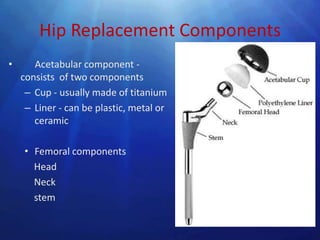 Hip Replacement Components
•      Acetabular component -
    consists of two components
     – Cup - usually made of titanium
     – Liner - can be plastic, metal or
       ceramic

    • Femoral components
      Head
      Neck
      stem
 