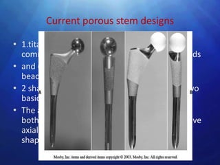 Current porous stem designs

• 1.titanium alloy with a porous surface of
  commercially pure titanium fiber-mesh or beads
• and (2) cobalt-chromium alloy with a sintered
  beaded surface.
• 2 shapes- Cementless total hip stems are of two
  basic shapes: straight and anatomical
• The aim of both types is to provide optimal fit
  both proximally and distally and thereby achieve
  axial and rotational stability by virtue of their
  shape
 