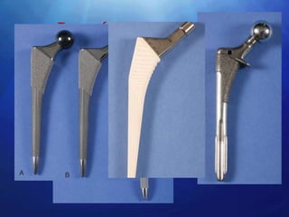 Types of porous coated stems
• Circumferential porous coating-first
  generation femoral stems
• Extensive coated stems
• Proximally coated stem – twice the incidence
  of thigh pain(stem tip abutment on the
  anterior cortex of femur)
• Tapered femoral stems
• Stems with hydroxyapetite coatings
 