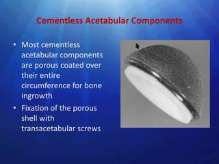 Cementless Acetabular Components

• Most cementless
  acetabular components
  are porous coated over
  their entire
  circumference for bone
  ingrowth
• Fixation of the porous
  shell with
  transacetabular screws
 