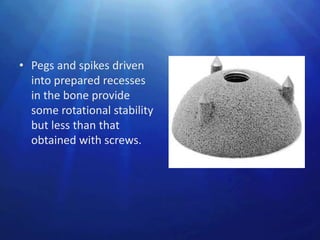 • Pegs and spikes driven
  into prepared recesses
  in the bone provide
  some rotational stability
  but less than that
  obtained with screws.
 