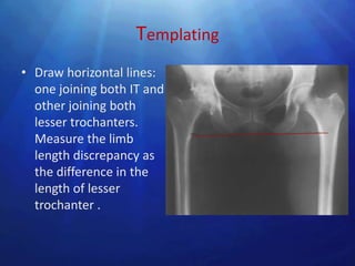 Templating
• Draw horizontal lines:
  one joining both IT and
  other joining both
  lesser trochanters.
  Measure the limb
  length discrepancy as
  the difference in the
  length of lesser
  trochanter .
 