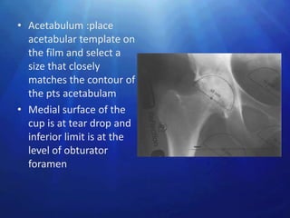 • Acetabulum :place
  acetabular template on
  the film and select a
  size that closely
  matches the contour of
  the pts acetabulam
• Medial surface of the
  cup is at tear drop and
  inferior limit is at the
  level of obturator
  foramen
 