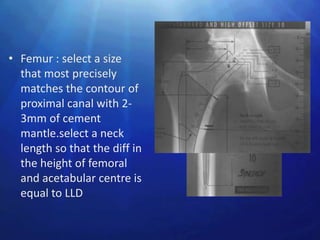 • Femur : select a size
  that most precisely
  matches the contour of
  proximal canal with 2-
  3mm of cement
  mantle.select a neck
  length so that the diff in
  the height of femoral
  and acetabular centre is
  equal to LLD
 