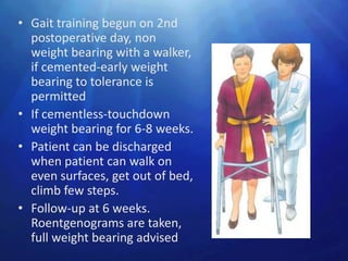 • Gait training begun on 2nd
  postoperative day, non
  weight bearing with a walker,
  if cemented-early weight
  bearing to tolerance is
  permitted
• If cementless-touchdown
  weight bearing for 6-8 weeks.
• Patient can be discharged
  when patient can walk on
  even surfaces, get out of bed,
  climb few steps.
• Follow-up at 6 weeks.
  Roentgenograms are taken,
  full weight bearing advised
 
